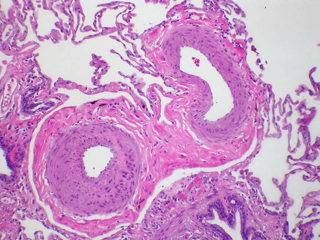 Use of selective Beta-3 adrenergic receptor agonists to treat pulmonary hypertension