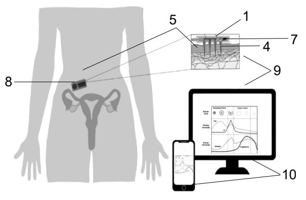 Microneedle biosensor and remote monitoring system for hormone treatment