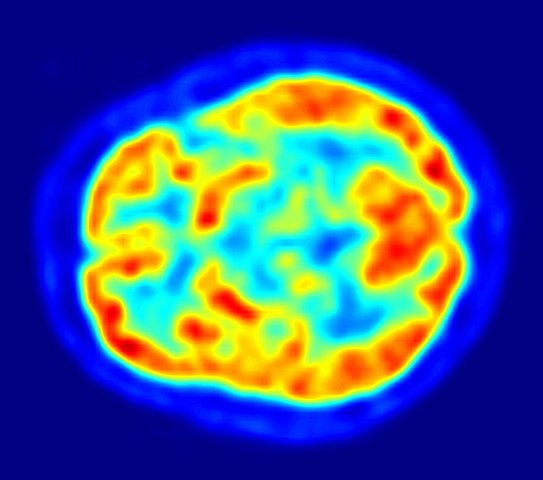 Treatment of L-DOPA-induced Dyskinesia in Parkinson’s Disease