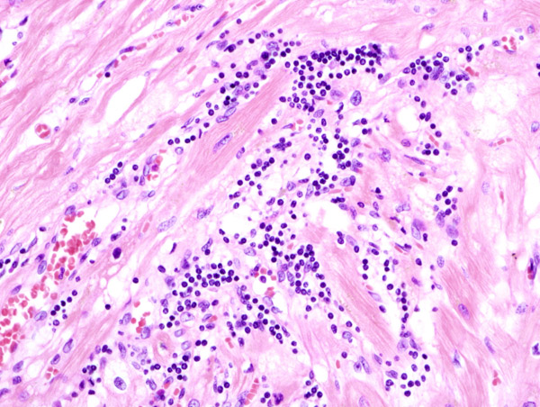 New microRNAs for the diagnosis of cardiomyopathies