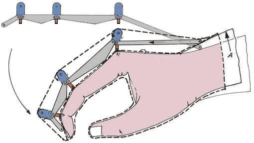 New orthotic glove designed to amplify hand strength