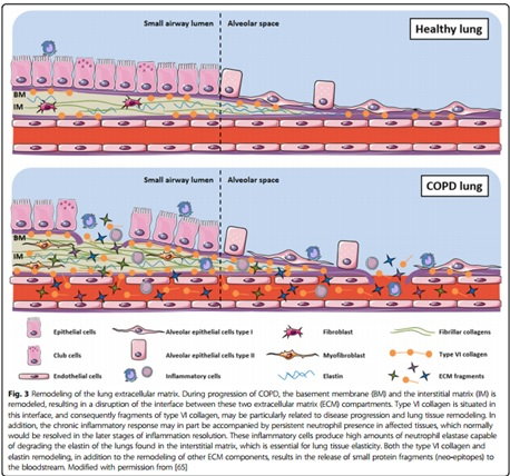 Method for isolating circulating epithelial pulmonary cells and their use as markers for diagnosing Chronic Obstructive Pulmonary Disease (COPD)